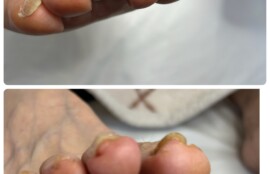 人差し指の巻き爪