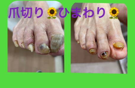 名古屋市瑞穂区豊岡通2-42-2　小林ビル1F 足の相談窓口 052-217-1122 無料カウンセリングを行っていますので、お気軽にお問合せください。 地下鉄桜通線　瑞穂運動場西下車　４番出口　徒歩1分 巻き爪、ウオノメ、タコ、角質、爪切り、連動操体法整体 Body and Foot　ひまわり