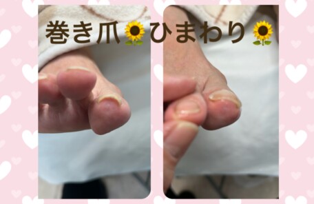 名古屋市瑞穂区豊岡通2-42-2　小林ビル1F 足のお悩み相談番号 （０５２）２１７－１１２２ 市営地下鉄桜通線　瑞穂運動場西下車　４番出口　徒歩１分 無料カウンセリングを行っていますので、お気軽にお問合せください。 当店では、巻き爪・タコ・魚の目・角質・爪切りなど、足に関するいろんなお悩みに対応しています♪
