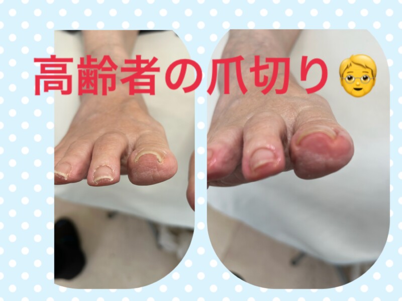 名古屋市瑞穂区豊岡通2-42-2　小林ビル1F 足のお悩み相談番号 （０５２）２１７－１１２２ 市営地下鉄桜通線　瑞穂運動場西下車　４番出口　徒歩１分 無料カウンセリングを行っていますので、お気軽にお問合せください。 当店では、巻き爪・タコ・魚の目・角質・爪切りなど、足に関するいろんなお悩みに対応しています♪