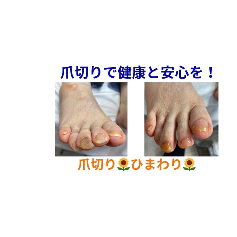 名古屋市瑞穂区豊岡通2-42-2　小林ビル1F 足のお悩み相談番号 （０５２）２１７－１１２２ 市営地下鉄桜通線　瑞穂運動場西下車　４番出口　徒歩１分 無料カウンセリングを行っていますので、お気軽にお問合せください。 当店では、巻き爪・タコ・魚の目・角質・爪切りなど、足に関するいろんなお悩みに対応しています♪