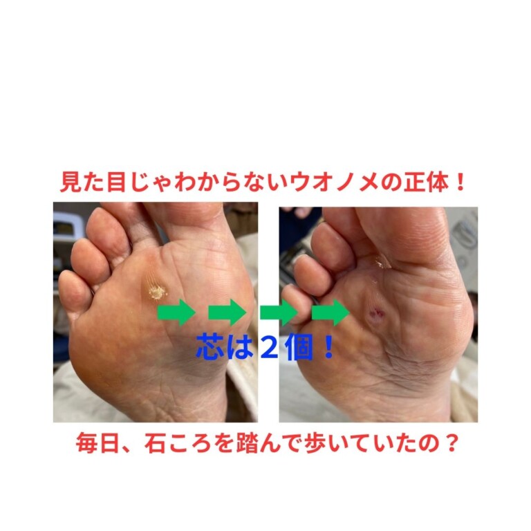 見た目以上に深い！芯を持つウオノメの正体 | 健康専科 ひまわり