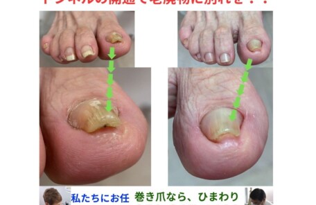 巻き爪が超肥厚してしまって！