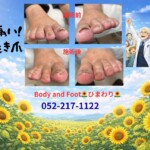 痛い巻き爪、我慢していませんか？