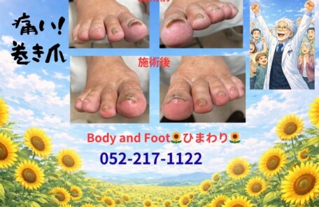 痛い巻き爪、我慢していませんか？