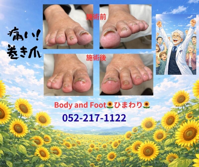 痛い巻き爪、我慢していませんか？