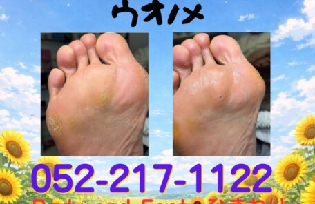 ウオノメ、タコ、巻き爪、角質、爪切り