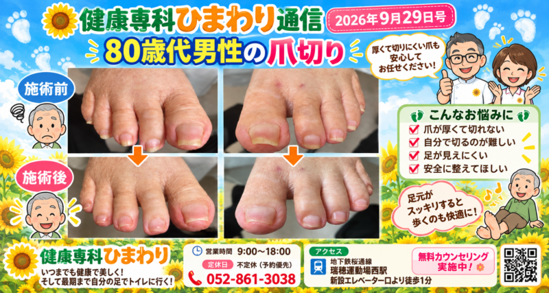 .爪切り、巻き爪、タコ、ウオノメ
