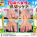 爪切り、爪切りケア、巻き爪、タコ、ウオノメ、角質